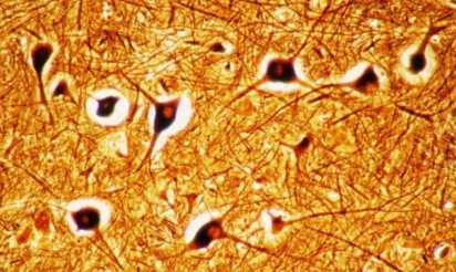 Bonne nouvelle, la greffe de neurones est désormais possible