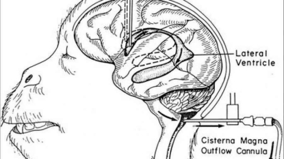 Un projet de transplantation de tête humaine laisse les spécialistes sceptiques