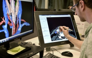 Cancer: un système de modélisation en 3D redonne espoir à des patients jugés inopérables