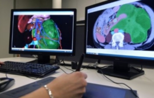 Cancer: un système de modélisation en 3D redonne espoir à des patients jugés inopérables