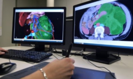 Cancer: un système de modélisation en 3D redonne espoir à des patients jugés inopérables